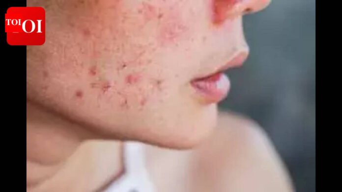 Why Your Acne Scars Won’t Go Away—Science Finds the Real Reason

