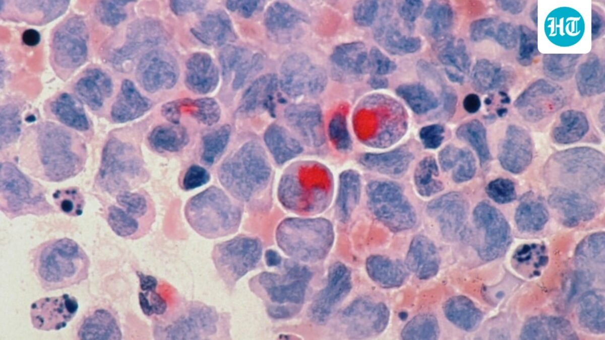 FDA officials gave expedited approval to daraxonrasib, which blocks a mutated protein that fuels tumor growth. (Representational) (Unsplash)