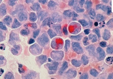 FDA officials gave expedited approval to daraxonrasib, which blocks a mutated protein that fuels tumor growth. (Representational) (Unsplash)
